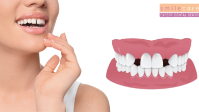 how to fill a missing tooth gap at home