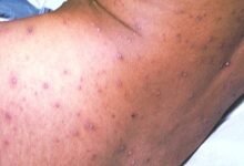 chicken pox on black skin