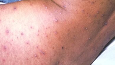 chicken pox on black skin