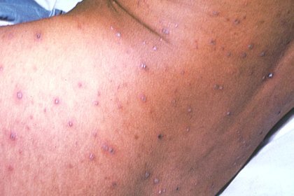 chicken pox on black skin