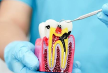 root canal near me