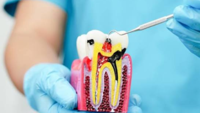 root canal near me