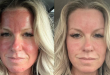 morpheus 8 before and after
