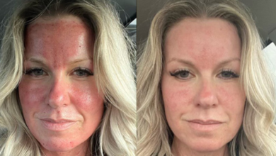 morpheus 8 before and after