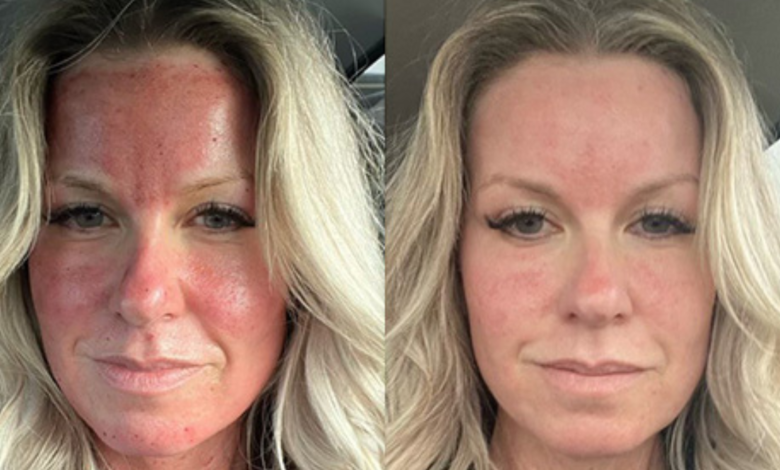 morpheus 8 before and after