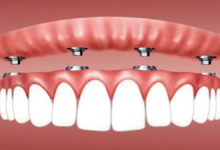 snap in dentures near me