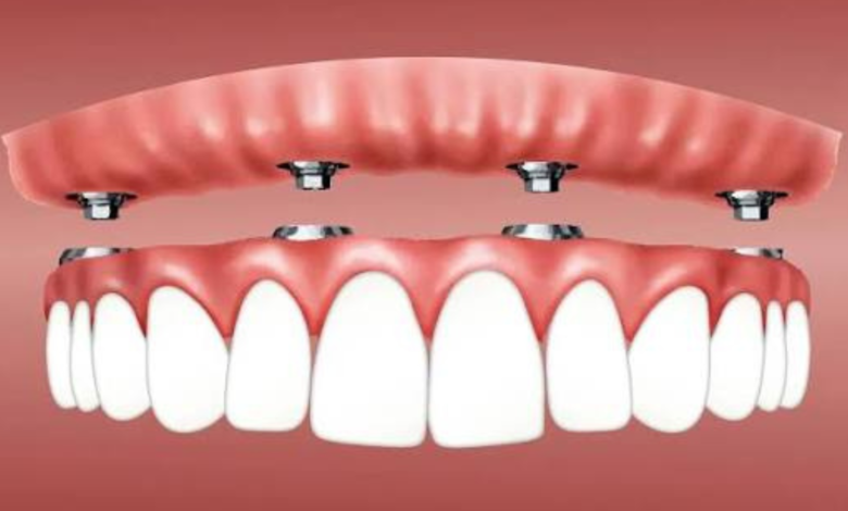 snap in dentures near me