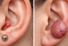 piercing bump vs keloid