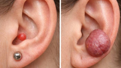 piercing bump vs keloid