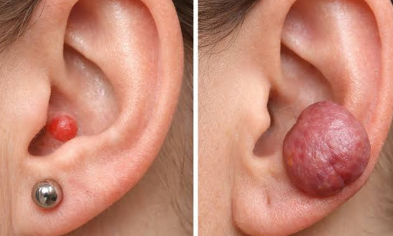 piercing bump vs keloid